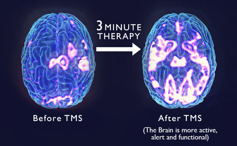 Effect of TMS on brain